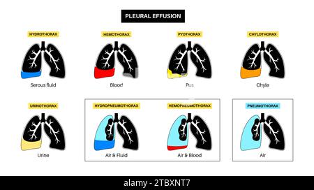 Pleural Effusion And Pneumothorax, Illustration Stock Photo - Alamy