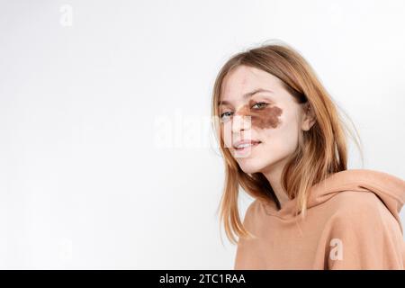 Portrait of a beautiful authentic girl light beige hoodie with birthmarks face on her face No makeup Stock Photo