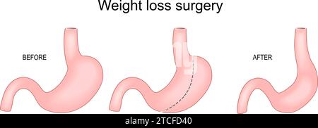 Weight loss surgery. Sleeve gastrectomy. Bariatric surgery. Showing the stomach before and after procedure. reduced, new stomach is the gastric sleeve Stock Vector