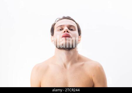 Allergic reaction on the lip angioedema in a man, consequences of hyaluronic acid injections Stock Photo