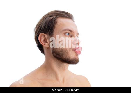 Allergic reaction on the lip angioedema in a man, consequences of hyaluronic acid injections Stock Photo