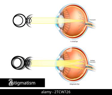 Vision of Normal eye and Astigmatic Stock Vector Image & Art - Alamy
