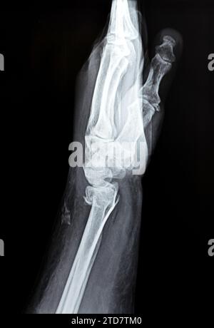 Colles' fracture of an old female, a type of fracture of the distal forearm in which the broken end of the radius is bent backwards, as a result of a Stock Photo