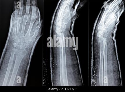 Colles fracture reduction of an old female, a type of fracture of the distal forearm, the broken end of the radius is bent backwards, as a result of a Stock Photo