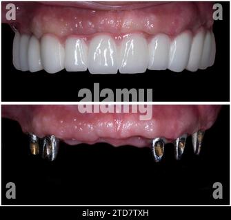 before and after picture of dental ceramic restoration on teeth and ...
