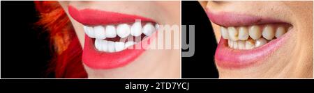 full mouth veneers bl1 color Stock Photo