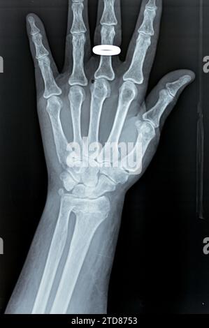 Colles' fracture of an old female, a type of fracture of the distal forearm in which the broken end of the radius is bent backwards, as a result of a Stock Photo