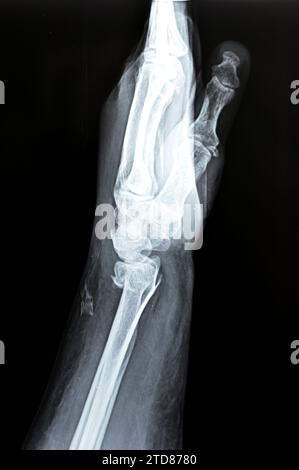 Colles' fracture of an old female, a type of fracture of the distal forearm in which the broken end of the radius is bent backwards, as a result of a Stock Photo