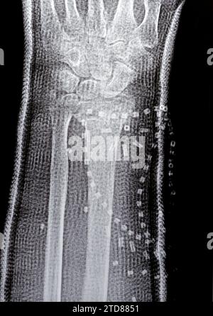 Colles fracture reduction of an old female, a type of fracture of the ...