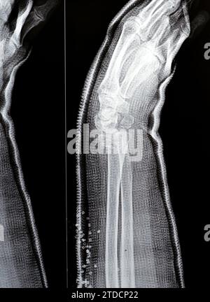 Colles fracture reduction of an old female, a type of fracture of the distal forearm, the broken end of the radius is bent backwards, as a result of a Stock Photo