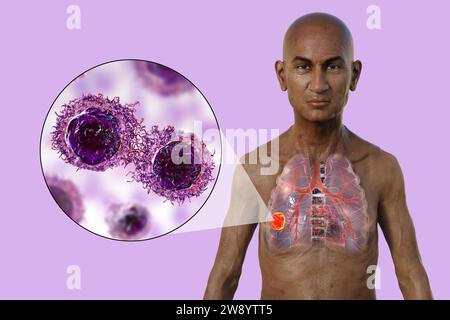 Man with lung cancer, illustration Stock Photo