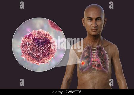 Man with lung cancer, illustration Stock Photo