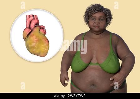 Overweight woman with enlarged heart, illustration Stock Photo