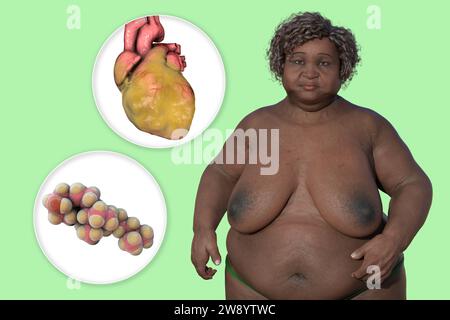 Overweight woman with enlarged heart, illustration Stock Photo