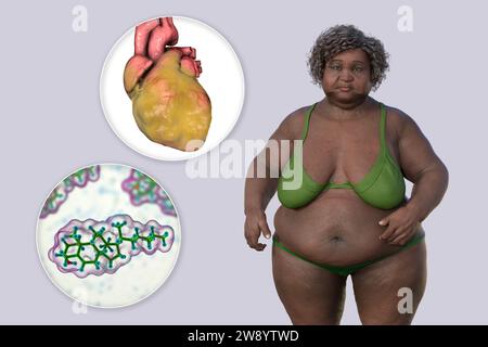 Overweight woman with enlarged heart, illustration Stock Photo