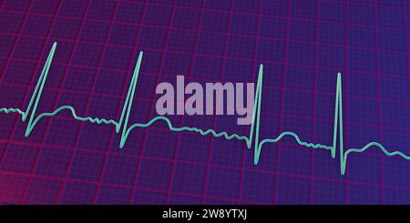 Atrial fibrillation irregular heartbeat rhythm, illustration Stock Photo