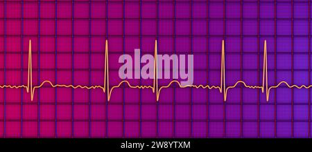 Atrial fibrillation irregular heartbeat rhythm, illustration Stock Photo
