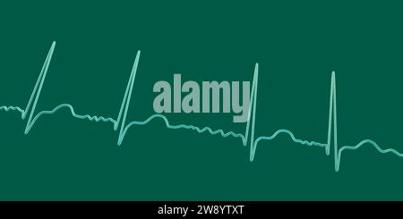 Atrial fibrillation irregular heartbeat rhythm, illustration Stock Photo