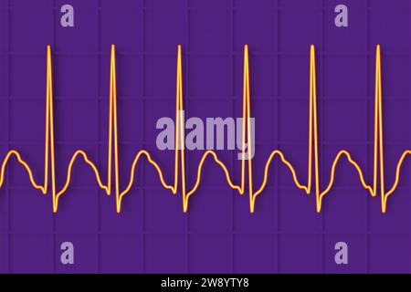 Illustration Depicting An Atrial Flutter Abnormal Heart Rhythm On An ...