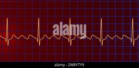 Atrial flutter abnormal heartbeat rhythm, illustration Stock Photo - Alamy
