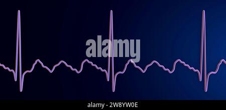 Illustration Depicting An Atrial Flutter Abnormal Heart Rhythm On An ...