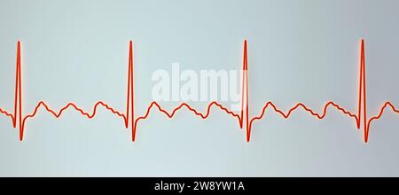 Illustration Depicting An Atrial Flutter Abnormal Heart Rhythm On An ...