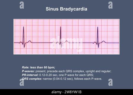 Illustration of an electrocardiogram (ECG) showing sinus bradycardia ...