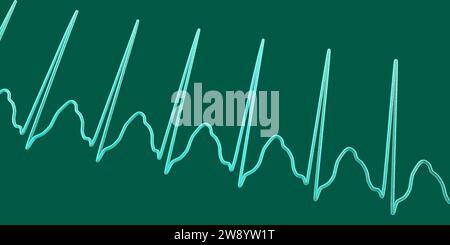 Supraventricular tachycardia heartbeat rhythm, illustration Stock Photo