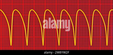 Ventricular tachycardia heartbeat rhythm, illustration Stock Photo