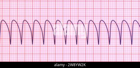 Ventricular tachycardia heartbeat rhythm, illustration Stock Photo