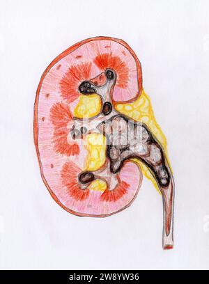 Kidney stones, illustration Stock Photo