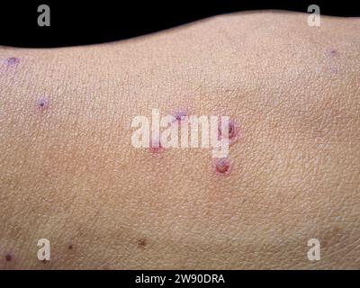 Itching skin lesions with scabs on the hand. Closeup view Stock Photo