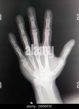 X-rayed human hand. X-ray of hand bones. Stock Photo