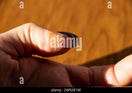 Allergic reaction and rash on finger, skin irritation, dry skin close-up Stock Photo