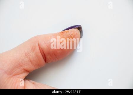 Allergic reaction and rash on finger, skin irritation, dry skin close-up Stock Photo