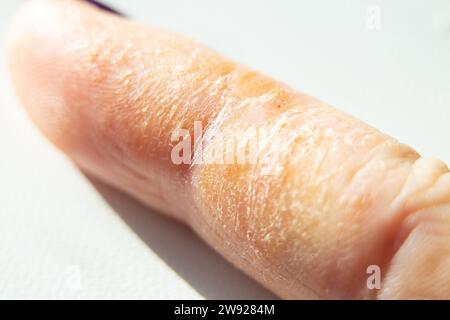 Allergic reaction and rash on finger, skin irritation, dry skin close-up Stock Photo