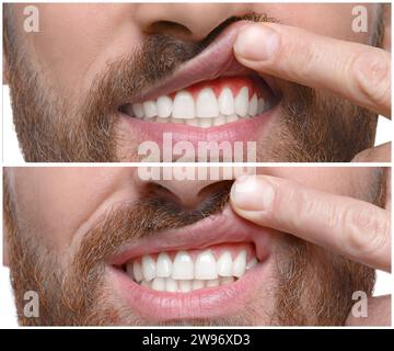 Man showing teeth before and after dental implant surgery, closeup ...
