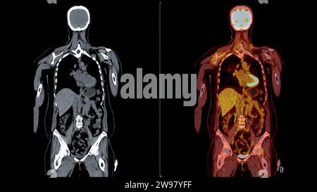 PET CT Scan fusion image It provides detailed images by merging ...