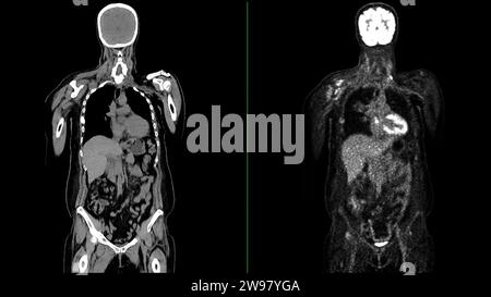 PET CT Scan fusion image It provides detailed images by merging ...
