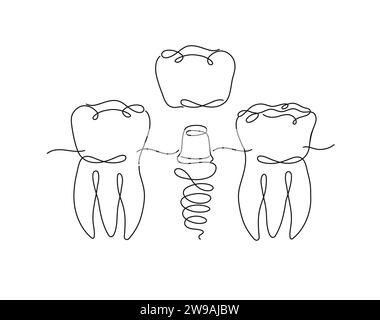 Teeth implant illustration drawing in flat line style on white background Stock Vector