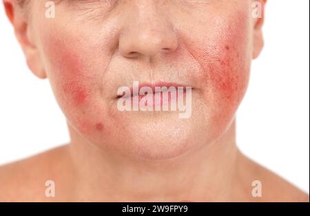 Woman with rosacea on white background, closeup. Problem skin treatment Stock Photo