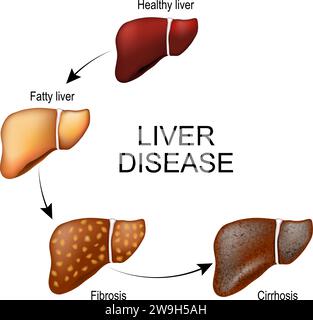 Liver disease. Changes of tissue of a human internal organ from healthy and Fatty liver to Fibrosis and Cirrhosis. Stages of liver damage. Vector illu Stock Vector