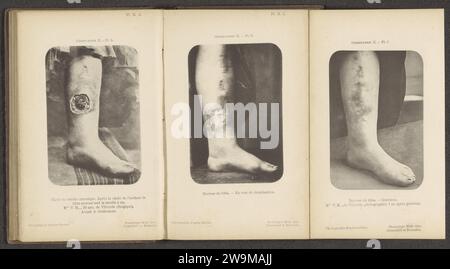 Shin with an infected wound or chronic inflammation, c. 1874 - in or before 1884 photomechanical print   paper collotype infections and wounds Stock Photo