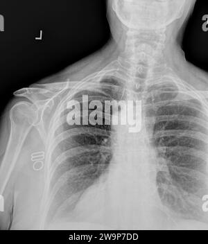 Film x ray or radiograph of a normal adult cervical vertebrae and left shoulder. anterior view showing normal bone structure of humerus, head glenohum Stock Photo