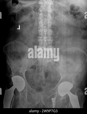 Film xray or radiograph of a lumbar spine, pelvis and hip. AP anterior posterior view showing bilateral hip replacement surgery with titanium screws Stock Photo