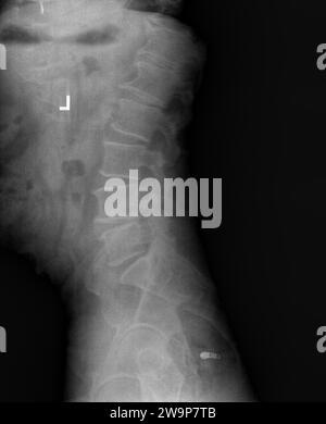 Film xray or radiograph of lumbar low back vertebrae showing facet joint syndrome of L4 L5 area which is an arthritis-like condition of the spine that Stock Photo