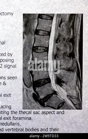 MRI lumbosacral spine shows L5 Vertebrae Spinal laminectomy evidence, posterior thecal sac decompression, lumbar spondylosis, posterior disc protrusio Stock Photo