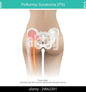 Piriformis syndrome. a condition in which nerve compression in the muscles, located in the buttock region causes buttocks pain and down to thigh in wo Stock Vector