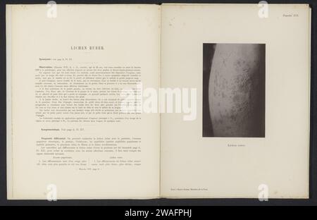 Patient suffering from the skin disease 'lichen ruber', c. 1890 - in or before 1900 photomechanical print  Amsterdampublisher: Haarlem paper collotype skin and venereal diseases. knee Stock Photo