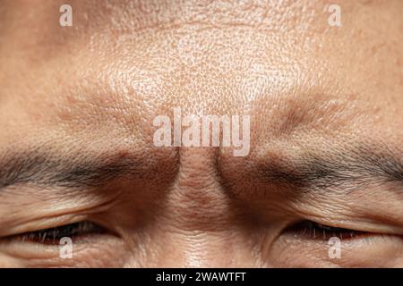 enlarged pores adult male face oily skin type, large wide pore with comedones closeup macro high detail cosmetic medical shot. Stock Photo